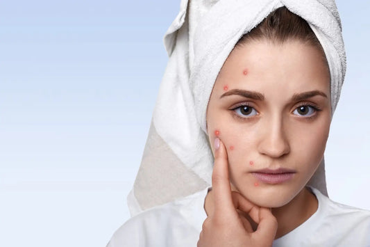 Three Acne Treatment Products You Need To Try