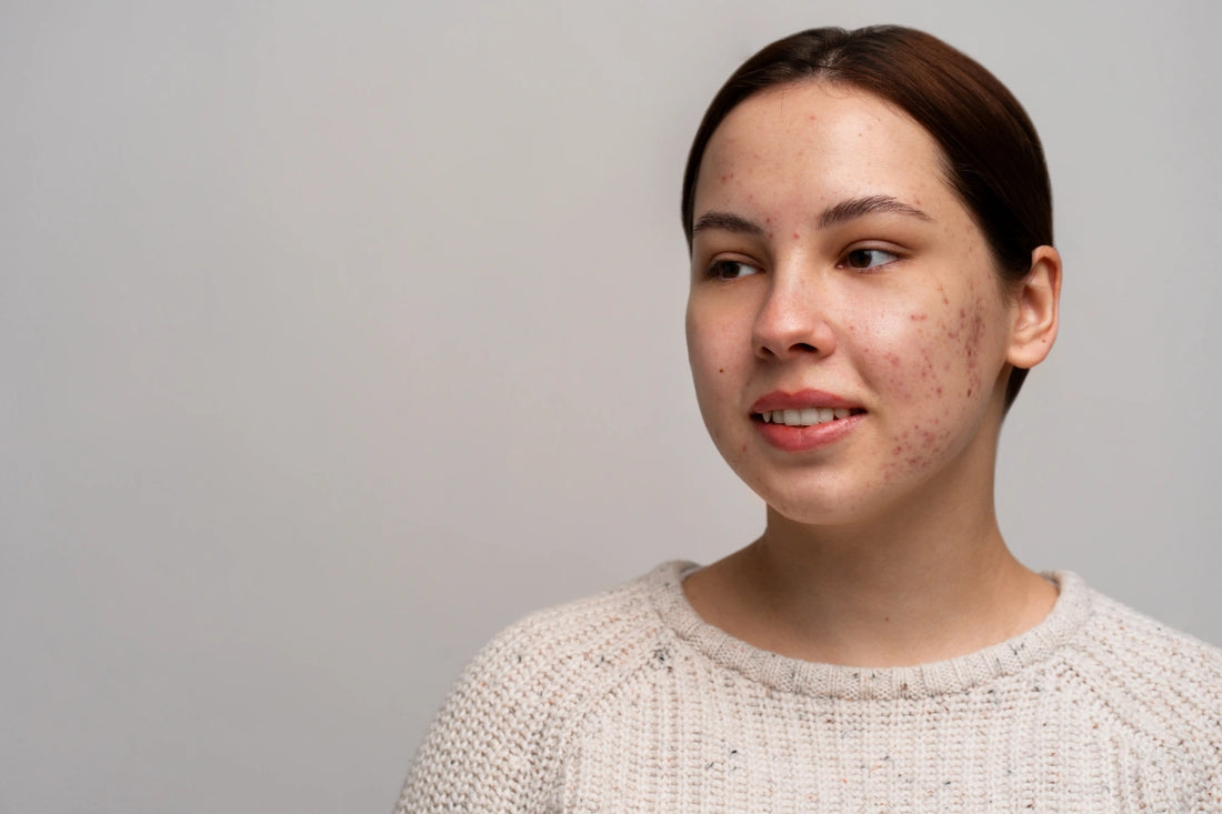 Acne treatment